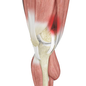 liotibial Band Syndrome